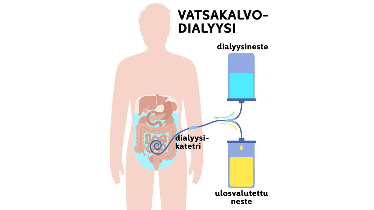 Kuvassa kaavio vatsakalvodialyysistä: dialyysikatateri vatsassa, sisään valutettava neste ja ulosvalutettu neste.